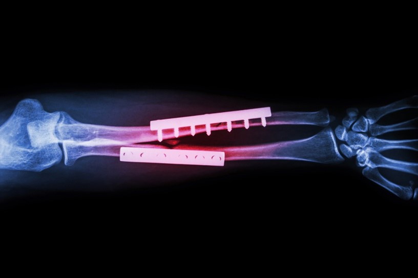 EMS with implants - TECNATIVES explains